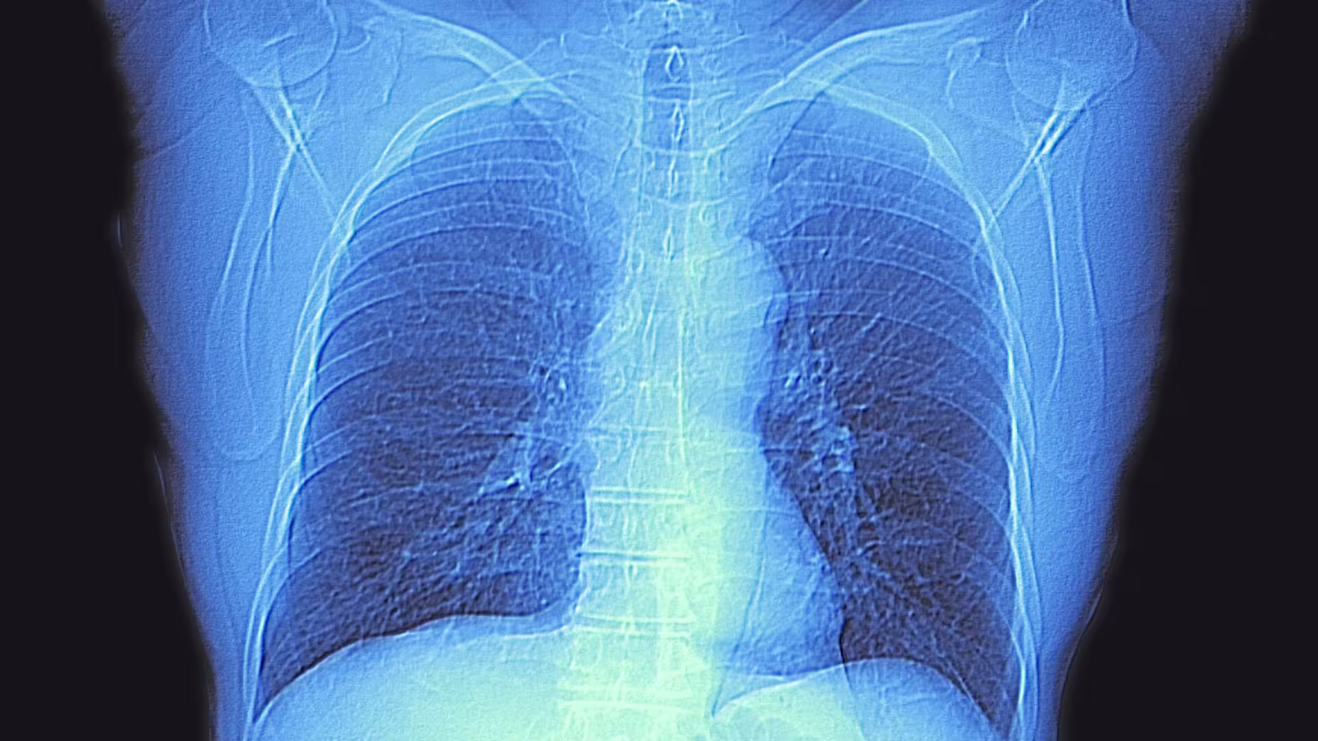 Ocena efektywności sztucznych sieci neuronowych w redukcji szumów na obrazach klatki piersiowej uzyskanych za pomocą różnych modalności tomografii komputerowej